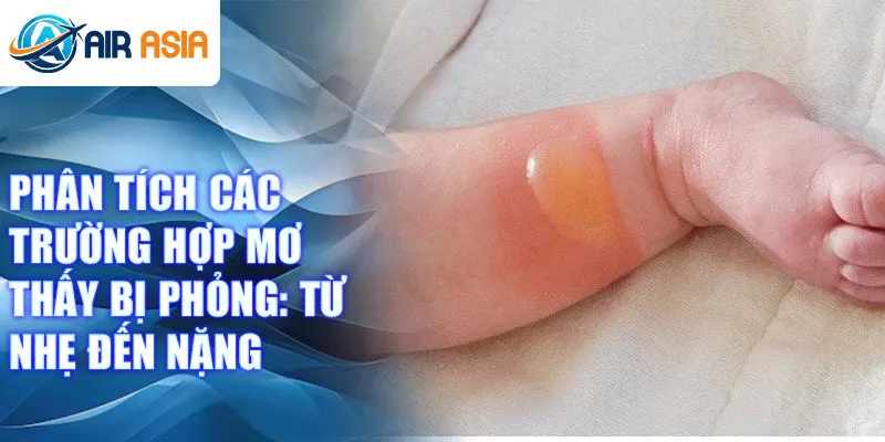 Phân tích các trường hợp mơ thấy bị phỏng: Từ nhẹ đến nặng